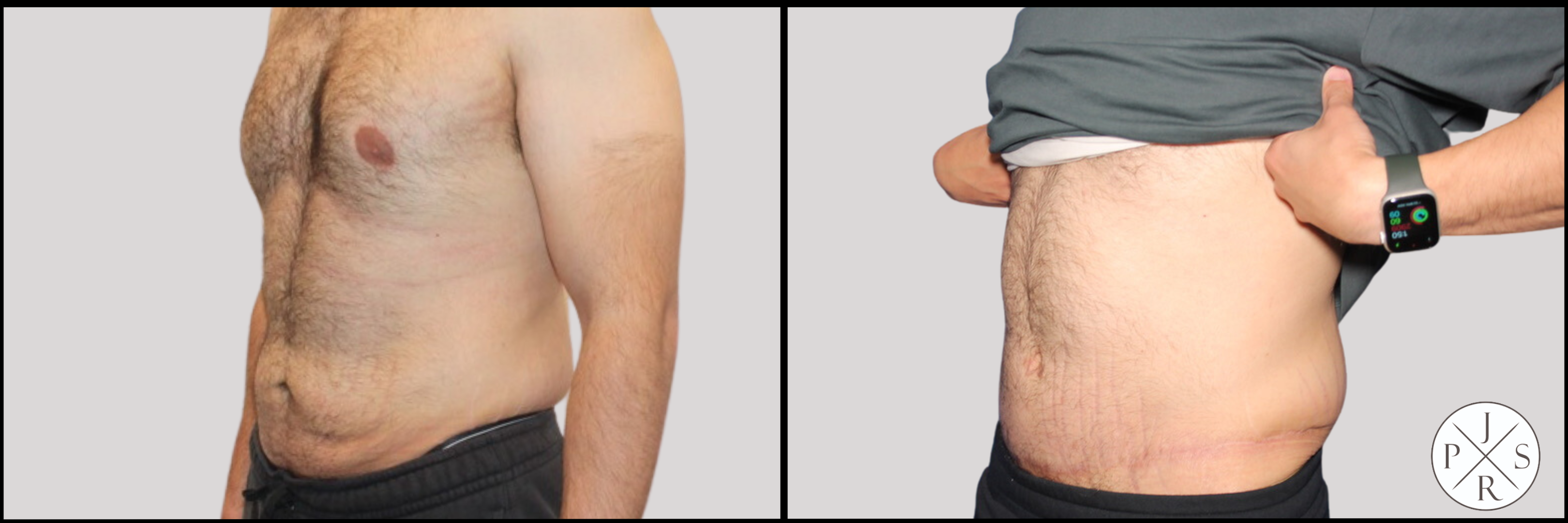 Abdominoplasty Before & After Image